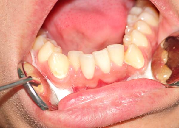 Teeth Crowding Facts & Treatment | Andrew W. Skorobatckyj, DDS | Parma, OH