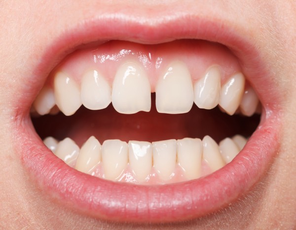 Tooth gap and diastema treatment