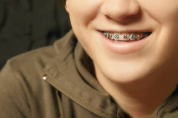 A child learning how to adjust to braces and smiling