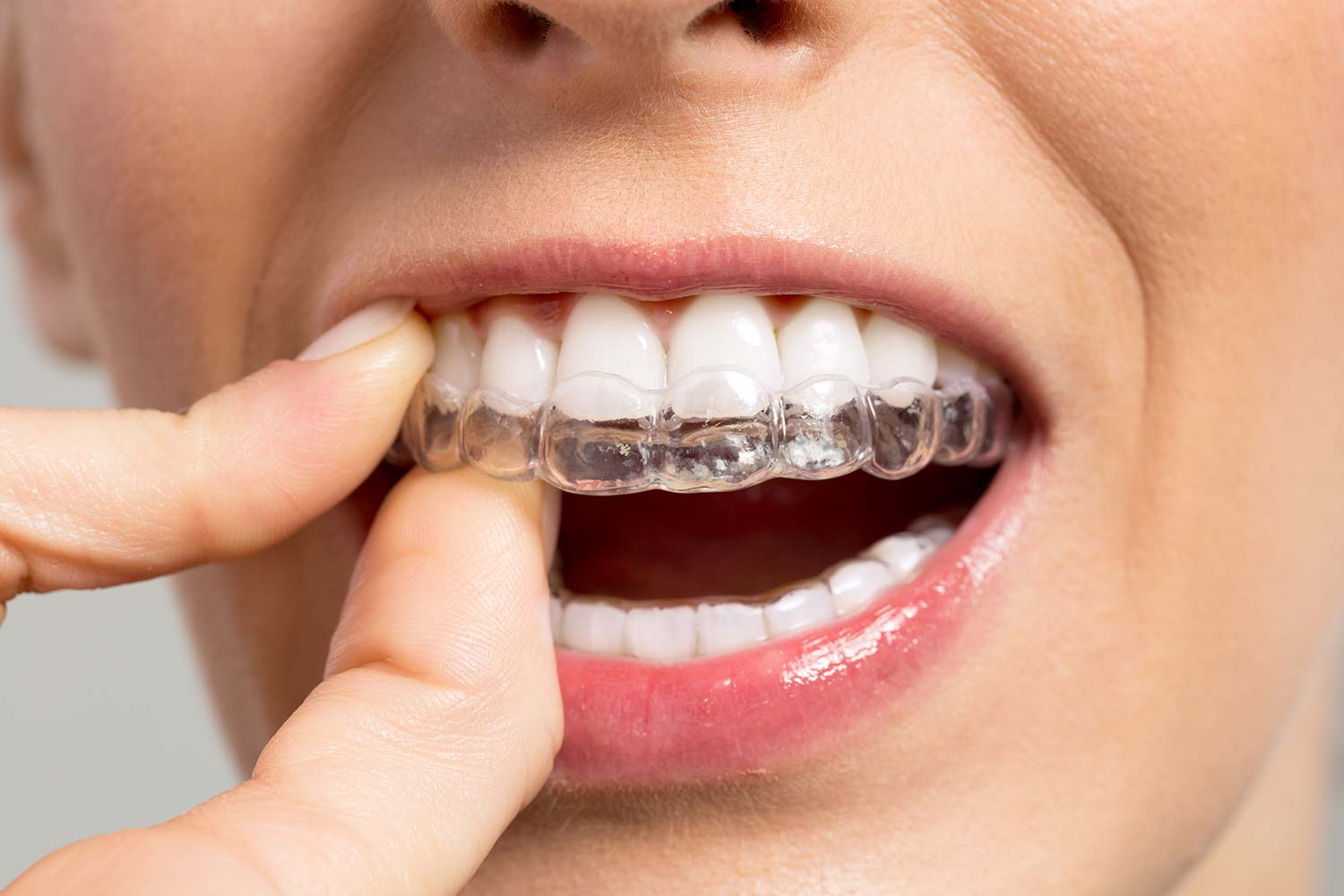 Woman putting orthodontic clear braces on her teeth