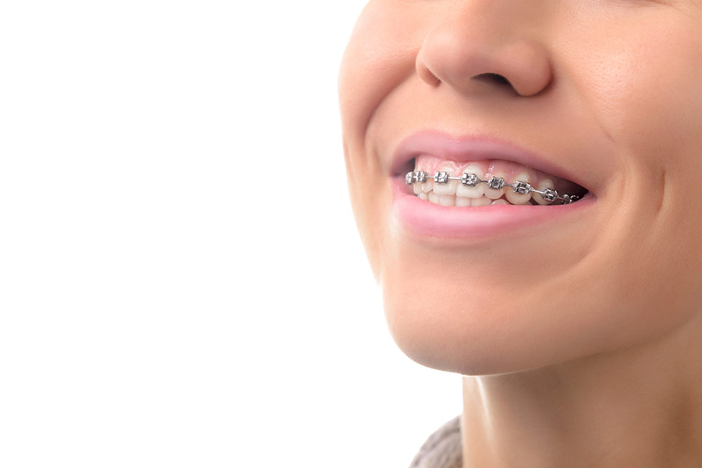 Smiling orthodontic patient with new braces