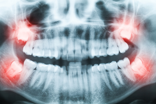 X-ray of a mouth highlighting the wisdom teeth