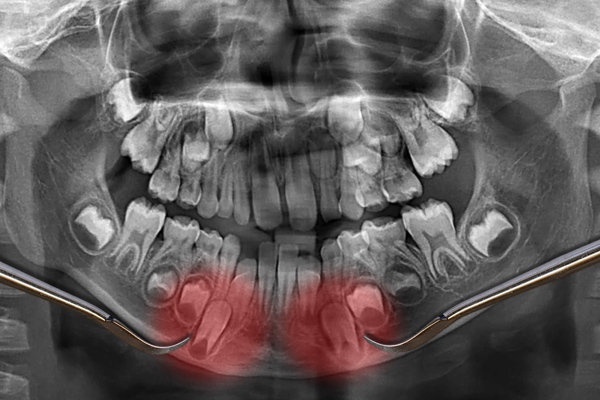 An x-ray for braces being used for orthodontic exam