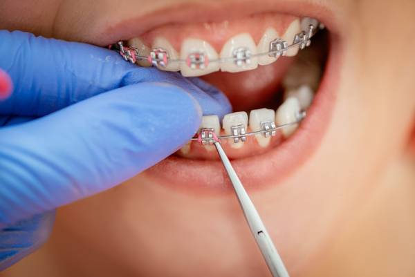 Braces can fix a number of issues from crooked teeth to a misaligned bite. Learn how a gummy smile can be fixed with braces.