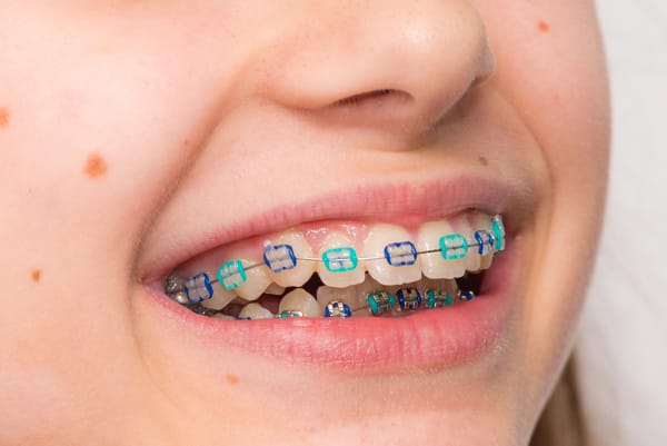 A child showing off one of the stages of braces for improving dental health