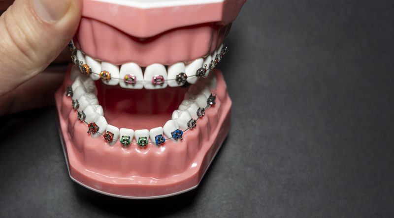 Teen choosing braces band colors from a color wheel at an orthodontic appointment
